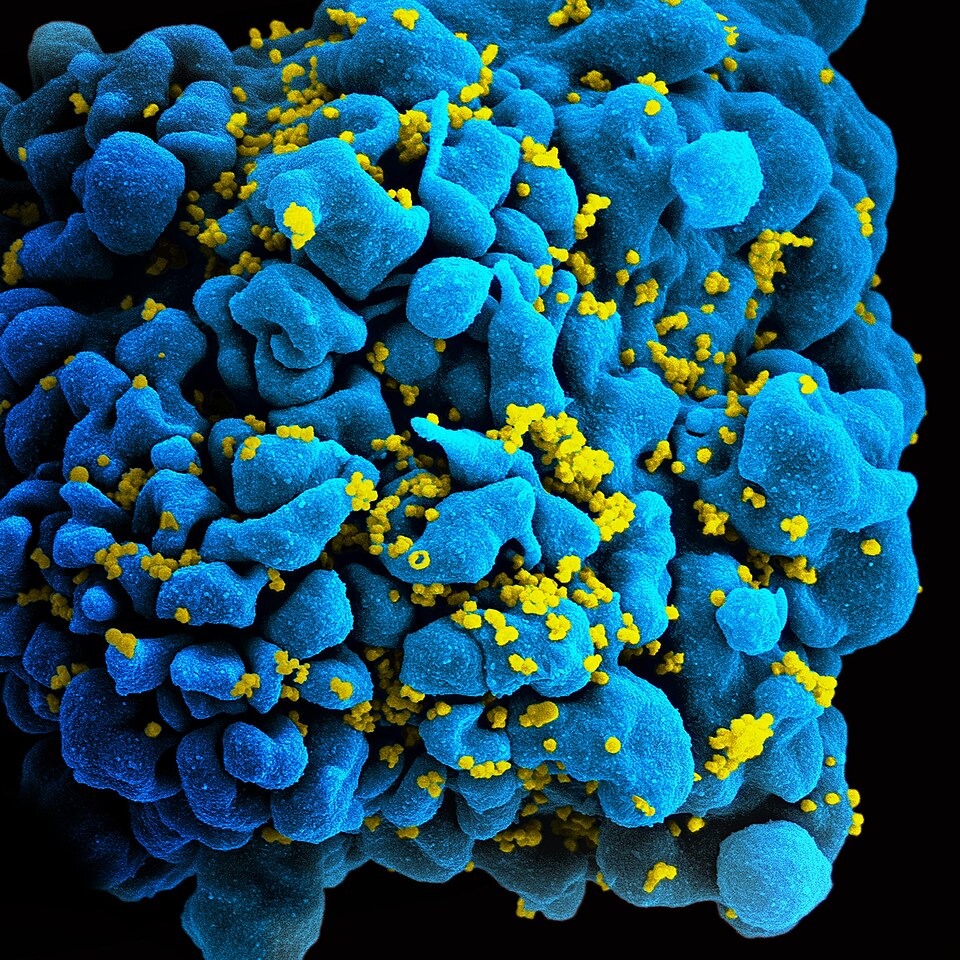 HIV Prevention Breakthrough Faces Challenges Over Cost and Patent Restrictions