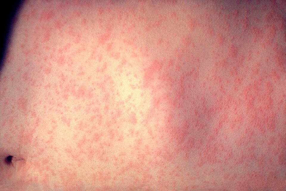 Measles Death Count Under Review as US Faces Major Outbreak